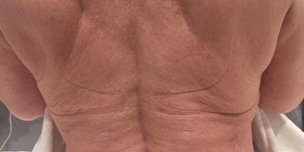 After Exilis skin tightening treatment showing firmer, smoother skin in Louisville
