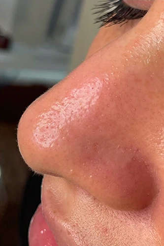 After HydraFacial MD treatment showing brighter, smoother, hydrated skin in Louisville