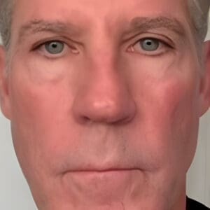 After NeoGen plasma skin rejuvenation showing firmer, smoother, more youthful-looking skin in Louisville