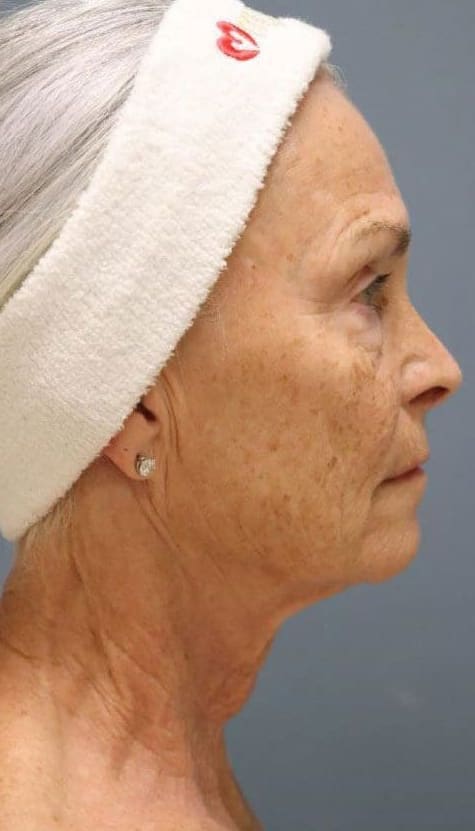 After Vivace RF microneedling treatment showing firmer, smoother, more even-looking skin in Louisville