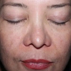 After ELEVAI exosome skincare showing improved skin clarity, tone, and texture in Louisville