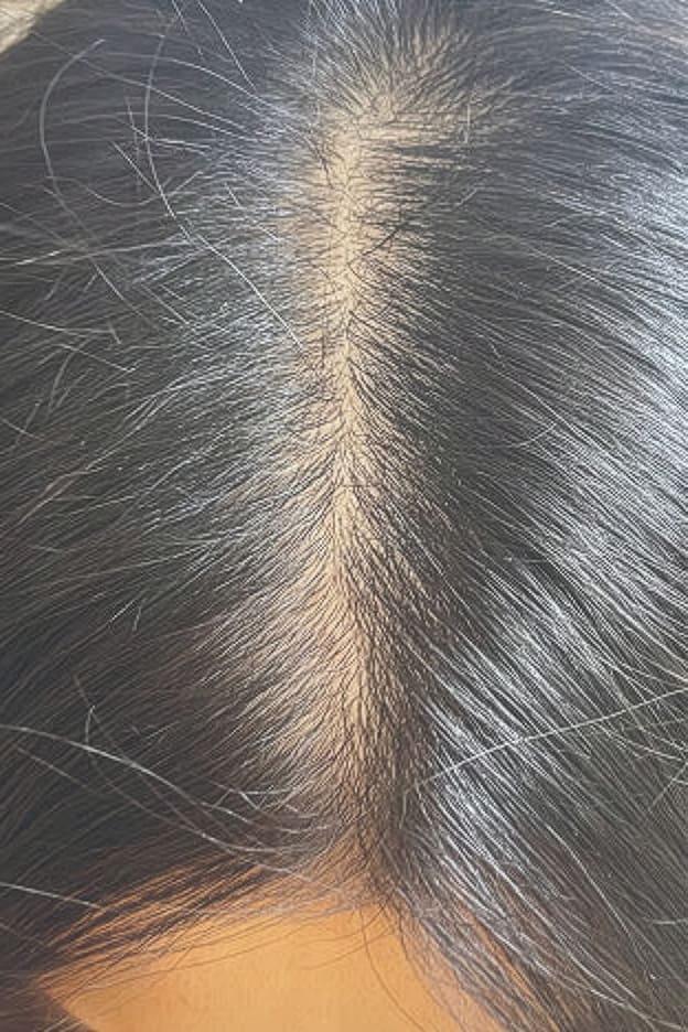 After HydraFacial Keravive treatment showing healthier scalp and fuller-looking hair in Louisville