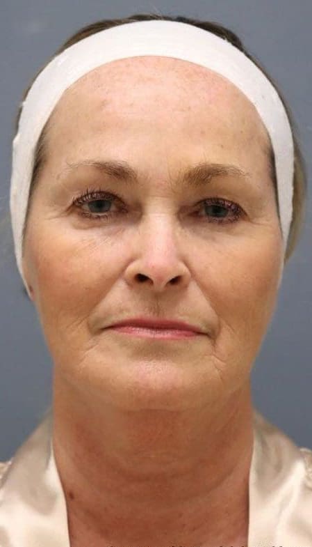 After Vivace RF microneedling treatment showing firmer, smoother, more even-looking skin in Louisville