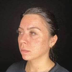 After ELEVAI exosome skincare showing improved skin clarity, tone, and texture in Louisville