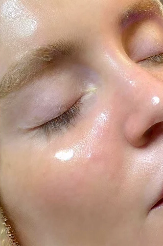 After HydraFacial MD treatment showing brighter, smoother, hydrated skin in Louisville