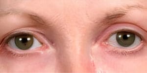 After NeoGen plasma skin rejuvenation showing firmer, smoother, more youthful-looking skin in Louisville