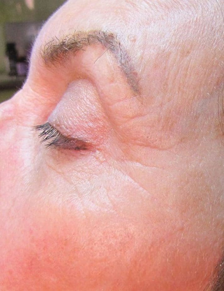 After Vivace RF microneedling treatment showing firmer, smoother, more even-looking skin in Louisville