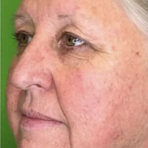 After ELEVAI exosome skincare showing improved skin clarity, tone, and texture in Louisville