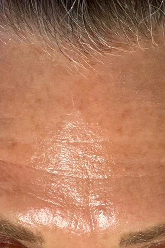 After HydraFacial MD treatment showing brighter, smoother, hydrated skin in Louisville