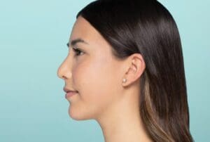 Facial profile after Restylane Defyne treatment with improved balance