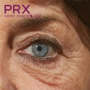 Before PRX Derm Perfexion treatment showing dull skin, fine lines, or uneven tone in Louisville