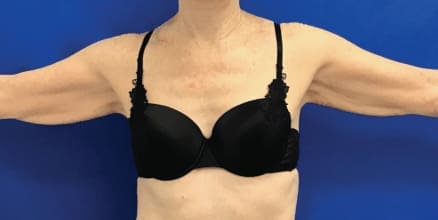 Before Renuvion J-Plasma skin tightening showing loose or sagging skin in Louisville