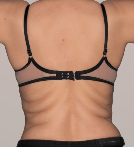 Before Renuvion J-Plasma skin tightening showing loose or sagging skin in Louisville