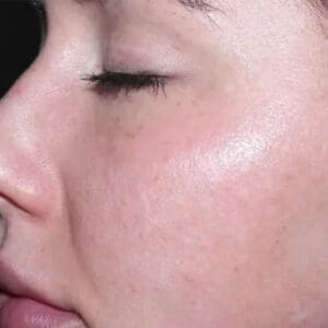 Before ELEVAI exosome skincare showing uneven skin tone and texture in Louisville