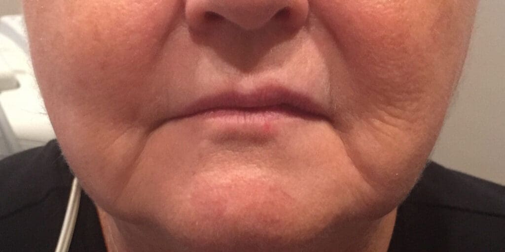 Before Exilis skin tightening treatment showing loose or sagging skin in Louisville