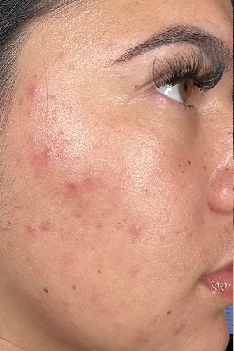 Before HydraFacial MD treatment showing dull skin, clogged pores, or uneven texture in Louisville