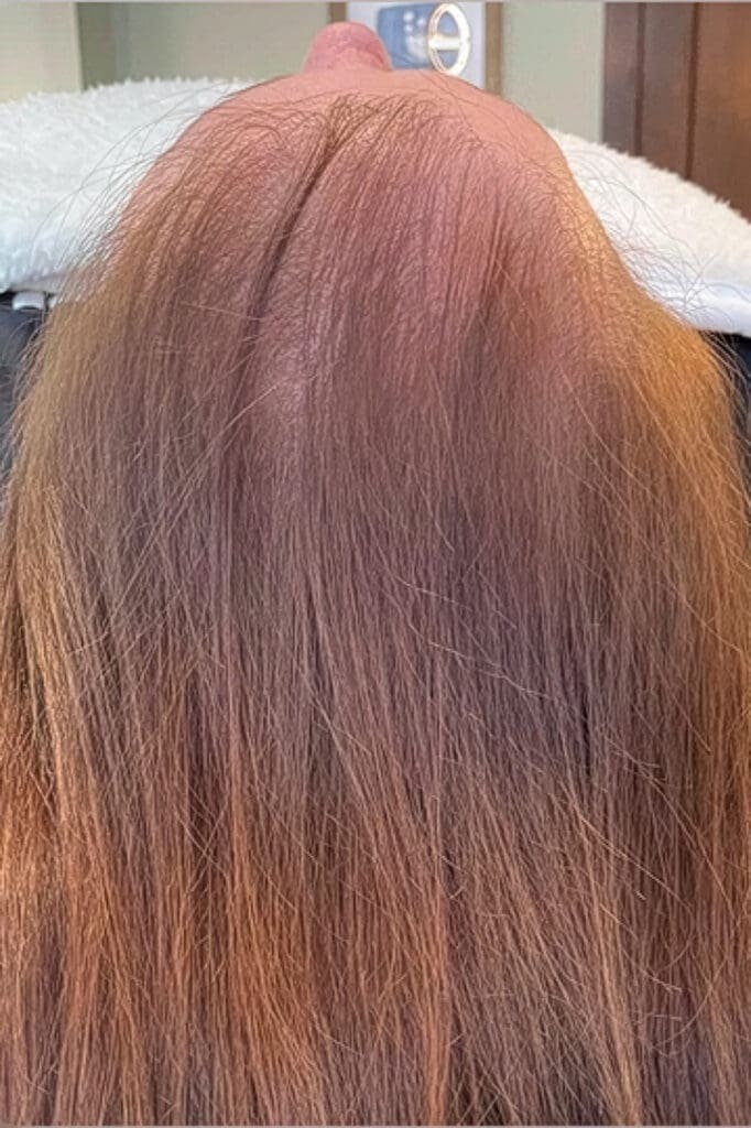 Before HydraFacial Keravive treatment showing dry scalp or thinning hair in Louisville