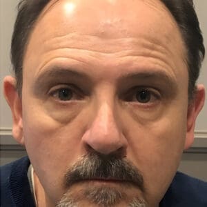 Before NeoGen plasma skin rejuvenation showing wrinkles, pigmentation, or skin laxity in Louisville