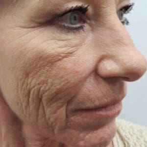 Before PRP therapy showing skin texture concerns or hair thinning in Louisville
