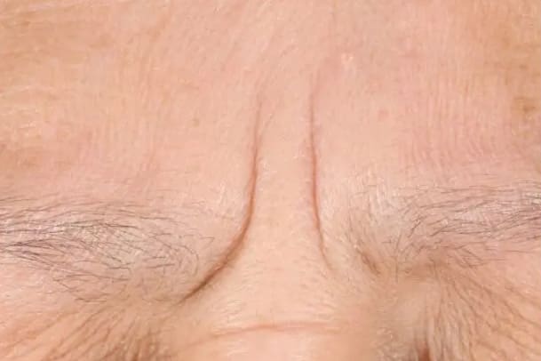 Before custom facial treatment showing dull skin, congestion, or dehydration in Louisville