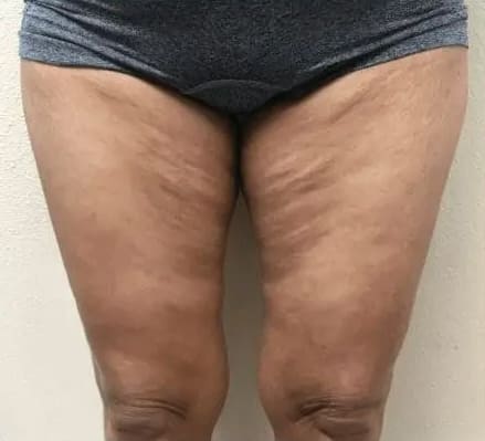 Before Renuvion J-Plasma skin tightening showing loose or sagging skin in Louisville