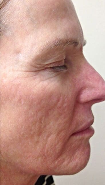 Before Vivace RF microneedling treatment showing fine lines, laxity, or uneven texture in Louisville