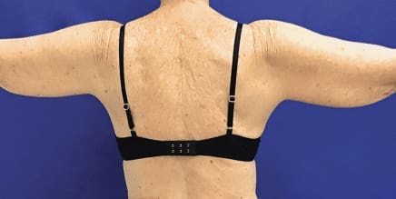 Before Renuvion J-Plasma skin tightening showing loose or sagging skin in Louisville