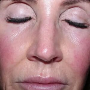 Before ELEVAI exosome skincare showing uneven skin tone and texture in Louisville
