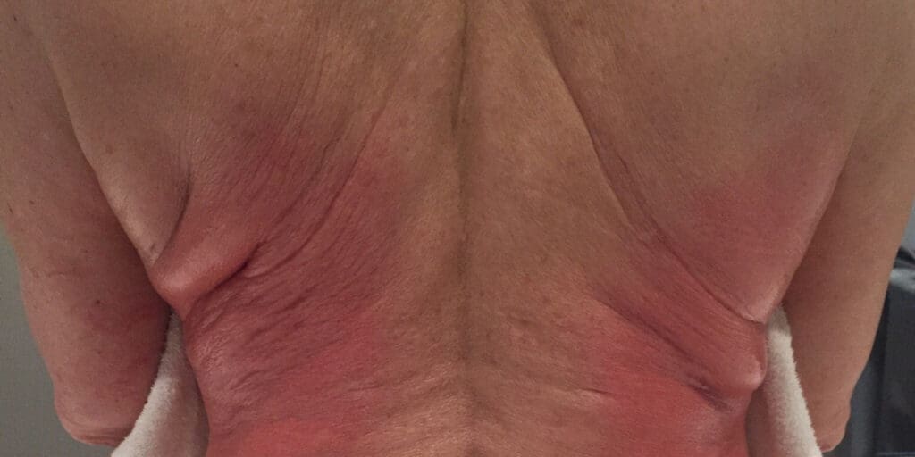 Before Exilis skin tightening treatment showing loose or sagging skin in Louisville