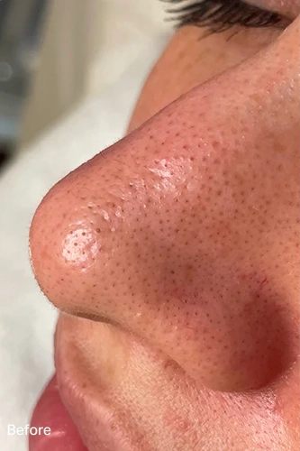 Before HydraFacial MD treatment showing dull skin, clogged pores, or uneven texture in Louisville