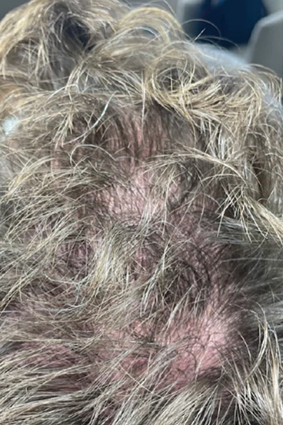 Before HydraFacial Keravive treatment showing dry scalp or thinning hair in Louisville