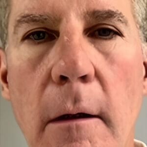 Before NeoGen plasma skin rejuvenation showing wrinkles, pigmentation, or skin laxity in Louisville