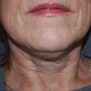 Before SkinTyte II skin tightening treatment showing loose or sagging skin in Louisville