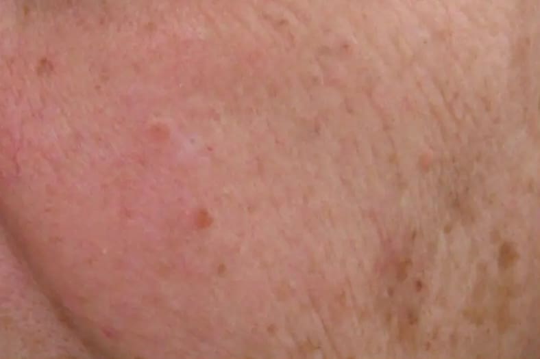 Before custom facial treatment showing dull skin, congestion, or dehydration in Louisville