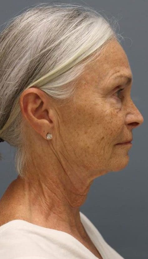 Before Vivace RF microneedling treatment showing fine lines, laxity, or uneven texture in Louisville