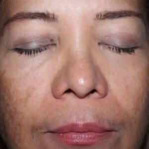 Before ELEVAI exosome skincare showing uneven skin tone and texture in Louisville