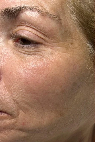 Before HydraFacial MD treatment showing dull skin, clogged pores, or uneven texture in Louisville