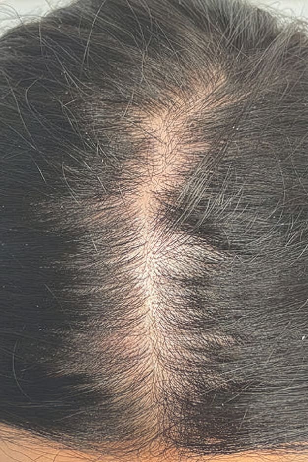 Before HydraFacial Keravive treatment showing dry scalp or thinning hair in Louisville
