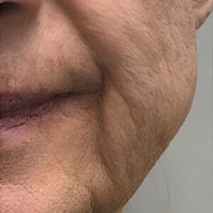 Before NeoGen plasma skin rejuvenation showing wrinkles, pigmentation, or skin laxity in Louisville