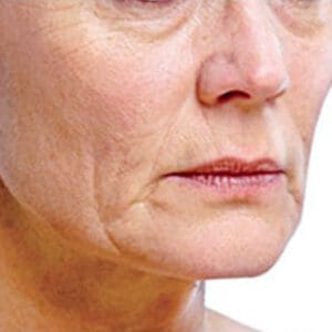 Before PRP therapy showing skin texture concerns or hair thinning in Louisville