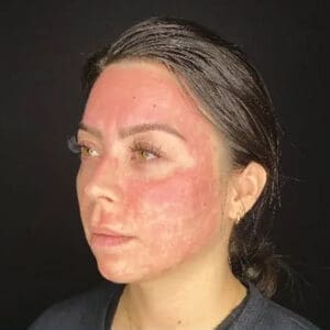 Before ELEVAI exosome skincare showing uneven skin tone and texture in Louisville
