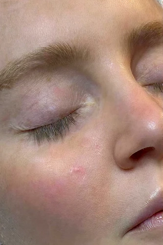 Before HydraFacial MD treatment showing dull skin, clogged pores, or uneven texture in Louisville
