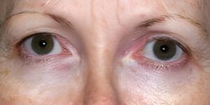Before NeoGen plasma skin rejuvenation showing wrinkles, pigmentation, or skin laxity in Louisville