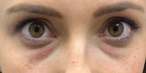 Before PRP therapy showing skin texture concerns or hair thinning in Louisville