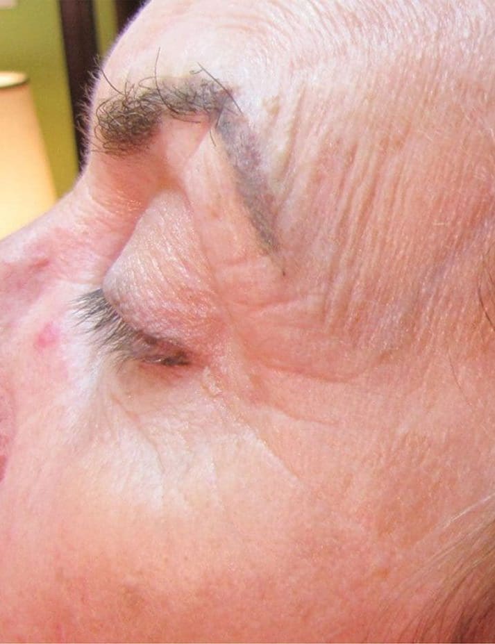 Before Vivace RF microneedling treatment showing fine lines, laxity, or uneven texture in Louisville