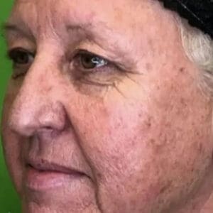 Before ELEVAI exosome skincare showing uneven skin tone and texture in Louisville