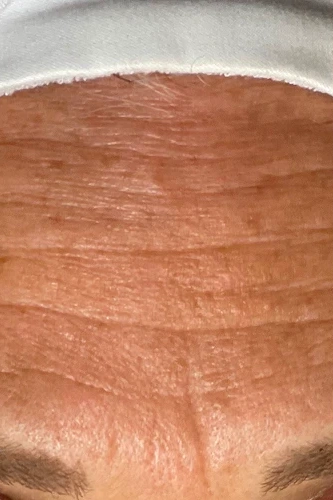 Before HydraFacial MD treatment showing dull skin, clogged pores, or uneven texture in Louisville