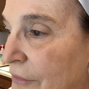 Before NeoGen plasma skin rejuvenation showing wrinkles, pigmentation, or skin laxity in Louisville