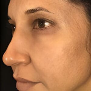 Before NeoGen plasma skin rejuvenation showing wrinkles, pigmentation, or skin laxity in Louisville