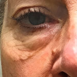 Before NeoGen plasma skin rejuvenation showing wrinkles, pigmentation, or skin laxity in Louisville